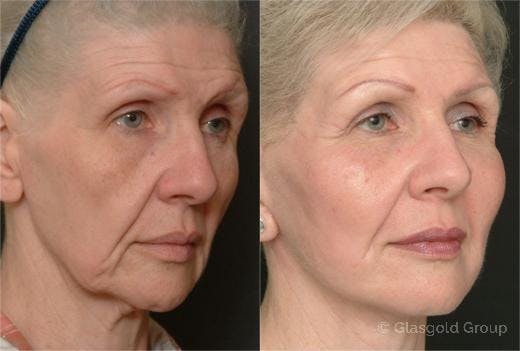 Fat Transfer Before & After Gallery - Patient 233464 - Image 1