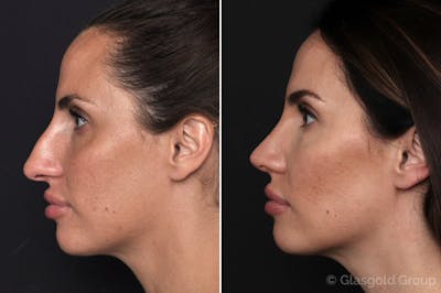 Rhinoplasty Before & After Gallery - Patient 224058 - Image 1