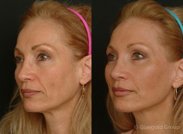 Facelift Before & After Gallery - Patient 302604 - Image 2