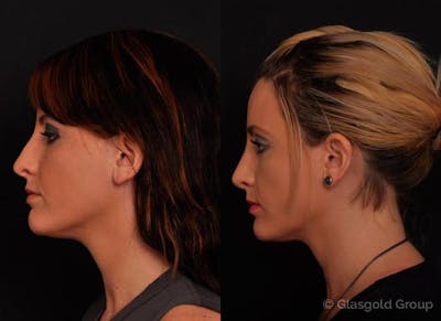 Revision Rhinoplasty Before & After Gallery - Patient 137317 - Image 1