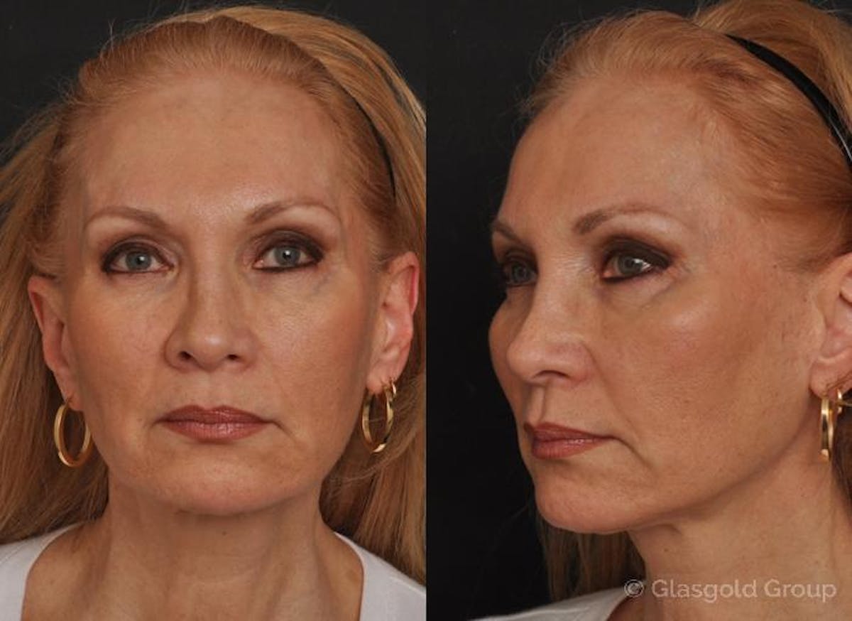 Facelift Before & After Gallery - Patient 302604 - Image 2