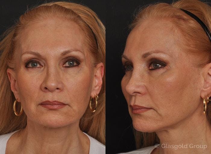 Facelift Before & After Gallery - Patient 302604 - Image 3