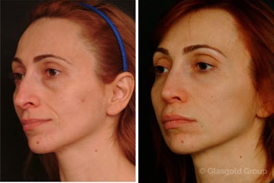 Fat Transfer Before & After Gallery - Patient 214399 - Image 1
