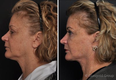 Facelift Before & After Gallery - Patient 382453 - Image 1