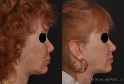 Revision Rhinoplasty Before & After Gallery - Patient 483818 - Image 1