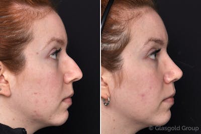 Rhinoplasty Before & After Gallery - Patient 306325 - Image 1