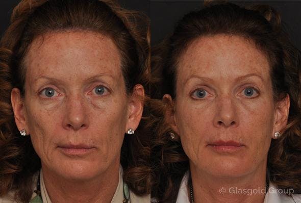 Fat Transfer Before & After Gallery - Patient 162849 - Image 3