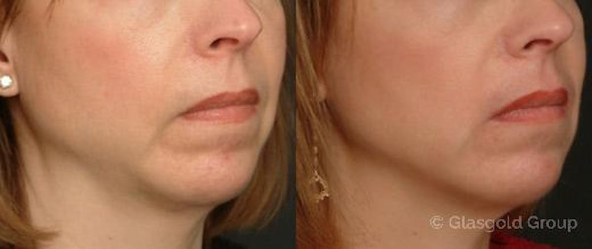 Jawline Lower Face Rejuvenation Before & After Gallery - Patient 635857 - Image 1