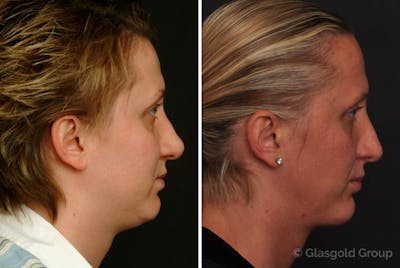 Revision Rhinoplasty Before & After Gallery - Patient 328290 - Image 1