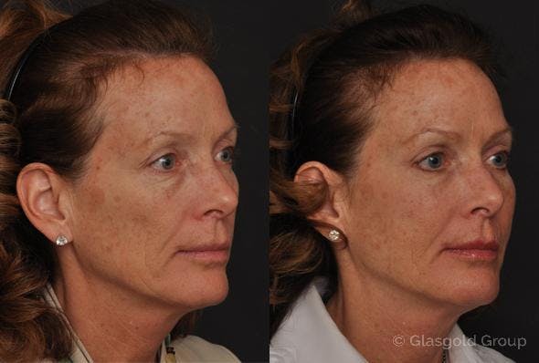 Fat Transfer Before & After Gallery - Patient 162849 - Image 1