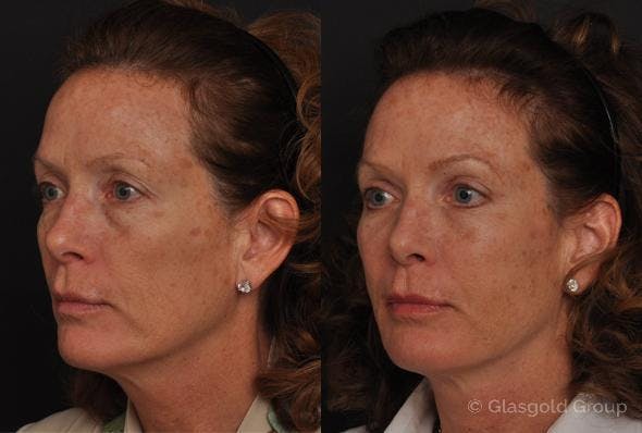 Fat Transfer Before & After Gallery - Patient 162849 - Image 2
