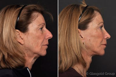 Facelift Before & After Gallery - Patient 247092 - Image 1