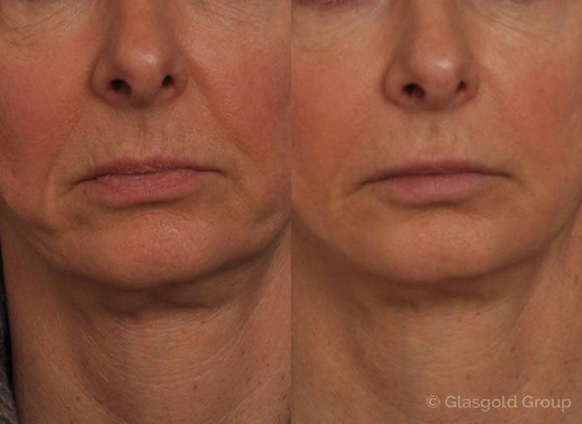 Jawline Lower Face Rejuvenation Before & After Gallery - Patient 357081 - Image 2