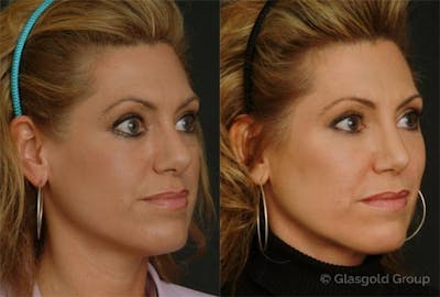 Fat Transfer Before & After Gallery - Patient 173794 - Image 1