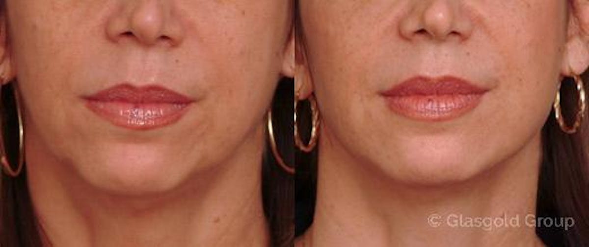 Jawline Lower Face Rejuvenation Before & After Gallery - Patient 116929 - Image 2
