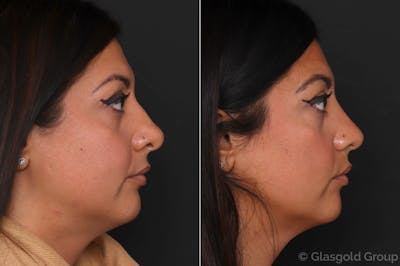 Rhinoplasty Before & After Gallery - Patient 399189 - Image 1