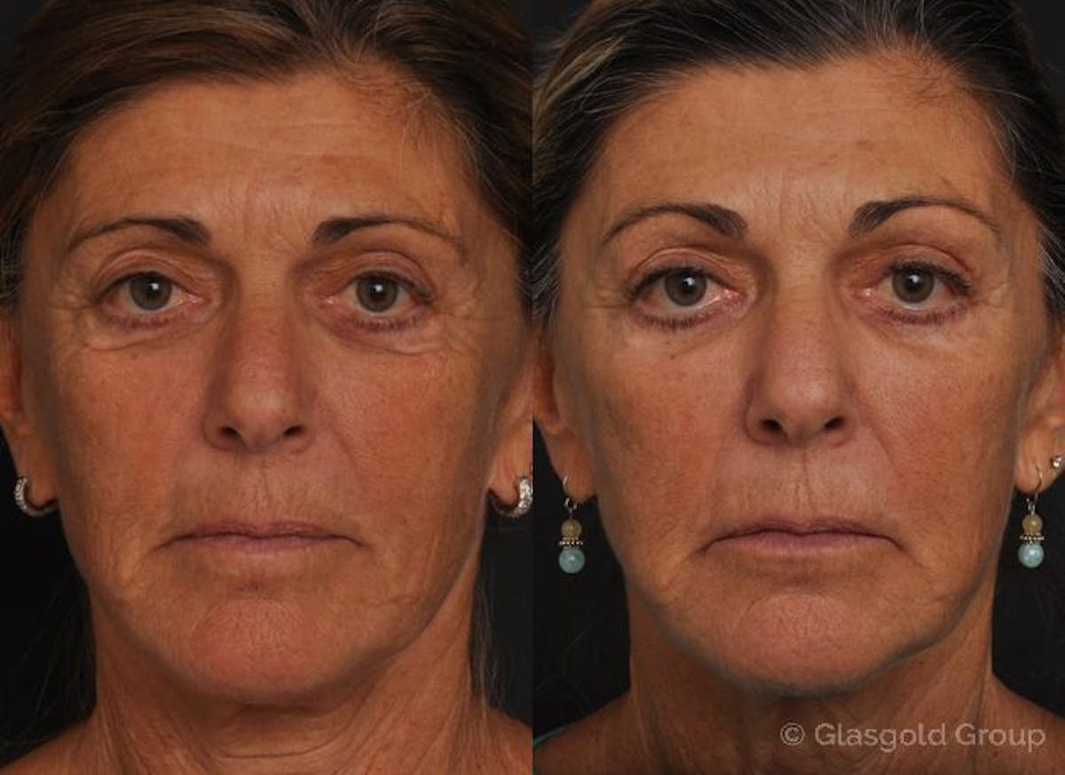 Fat Transfer Before & After Gallery - Patient 334017 - Image 2