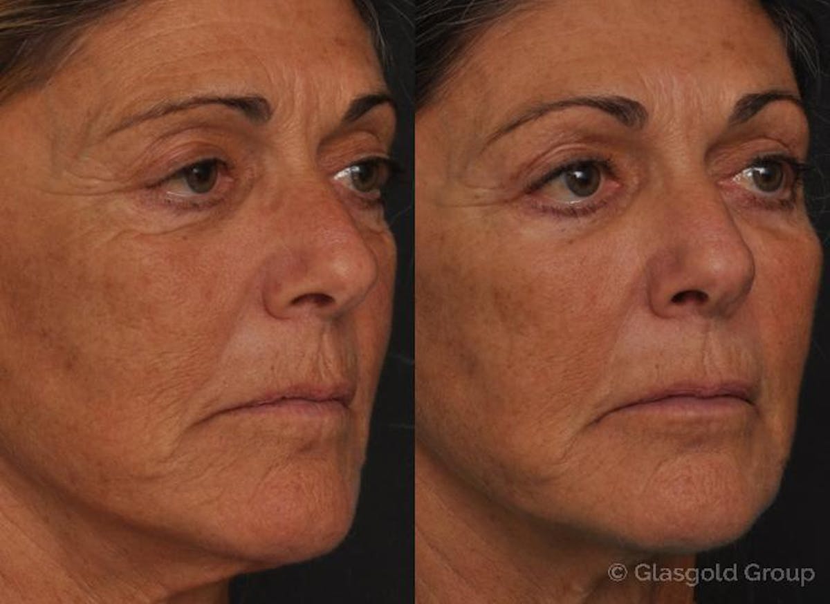 Fat Transfer Before & After Gallery - Patient 334017 - Image 1