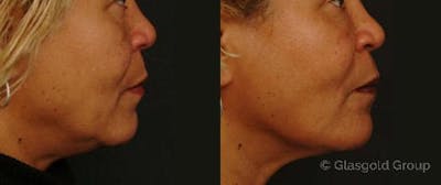 Jawline Lower Face Rejuvenation Before & After Gallery - Patient 350544 - Image 1