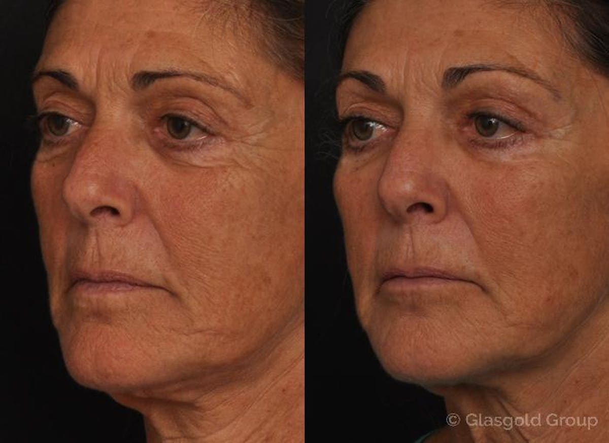 Fat Transfer Before & After Gallery - Patient 334017 - Image 3