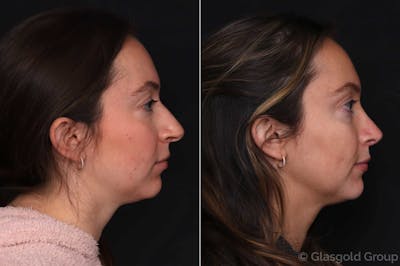 Rhinoplasty Before & After Gallery - Patient 108978 - Image 1