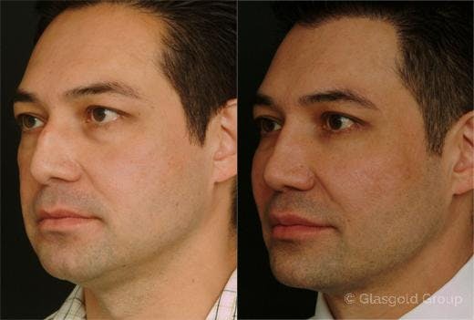 Fat Transfer Before & After Gallery - Patient 194821 - Image 1