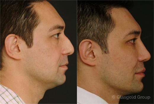 Fat Transfer Before & After Gallery - Patient 194821 - Image 2