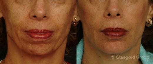 Jawline Lower Face Rejuvenation Before & After Gallery - Patient 346306 - Image 3