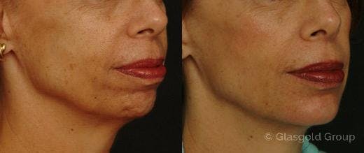 Jawline Lower Face Rejuvenation Before & After Gallery - Patient 346306 - Image 1