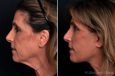 Facelift Before & After Gallery - Patient 359843 - Image 1