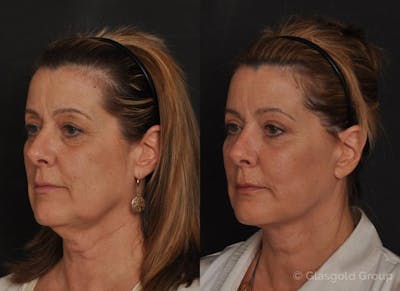 Fat Transfer Before & After Gallery - Patient 265271 - Image 1