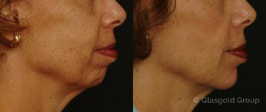 Jawline Lower Face Rejuvenation Before & After Gallery - Patient 346306 - Image 2