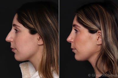 Rhinoplasty Before & After Gallery - Patient 670416 - Image 1