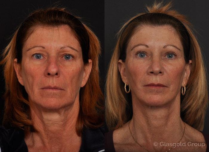 Fat Transfer Before & After Gallery - Patient 193634 - Image 3