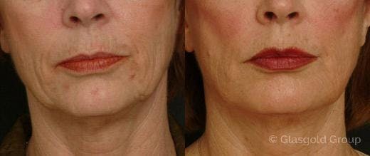Jawline Lower Face Rejuvenation Before & After Gallery - Patient 418974 - Image 2