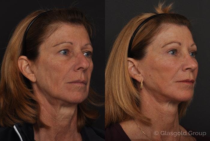 Fat Transfer Before & After Gallery - Patient 193634 - Image 1