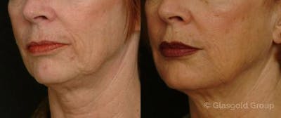 Jawline Lower Face Rejuvenation Before & After Gallery - Patient 418974 - Image 1