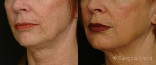 Jawline Lower Face Rejuvenation Before & After Gallery - Patient 418974 - Image 1