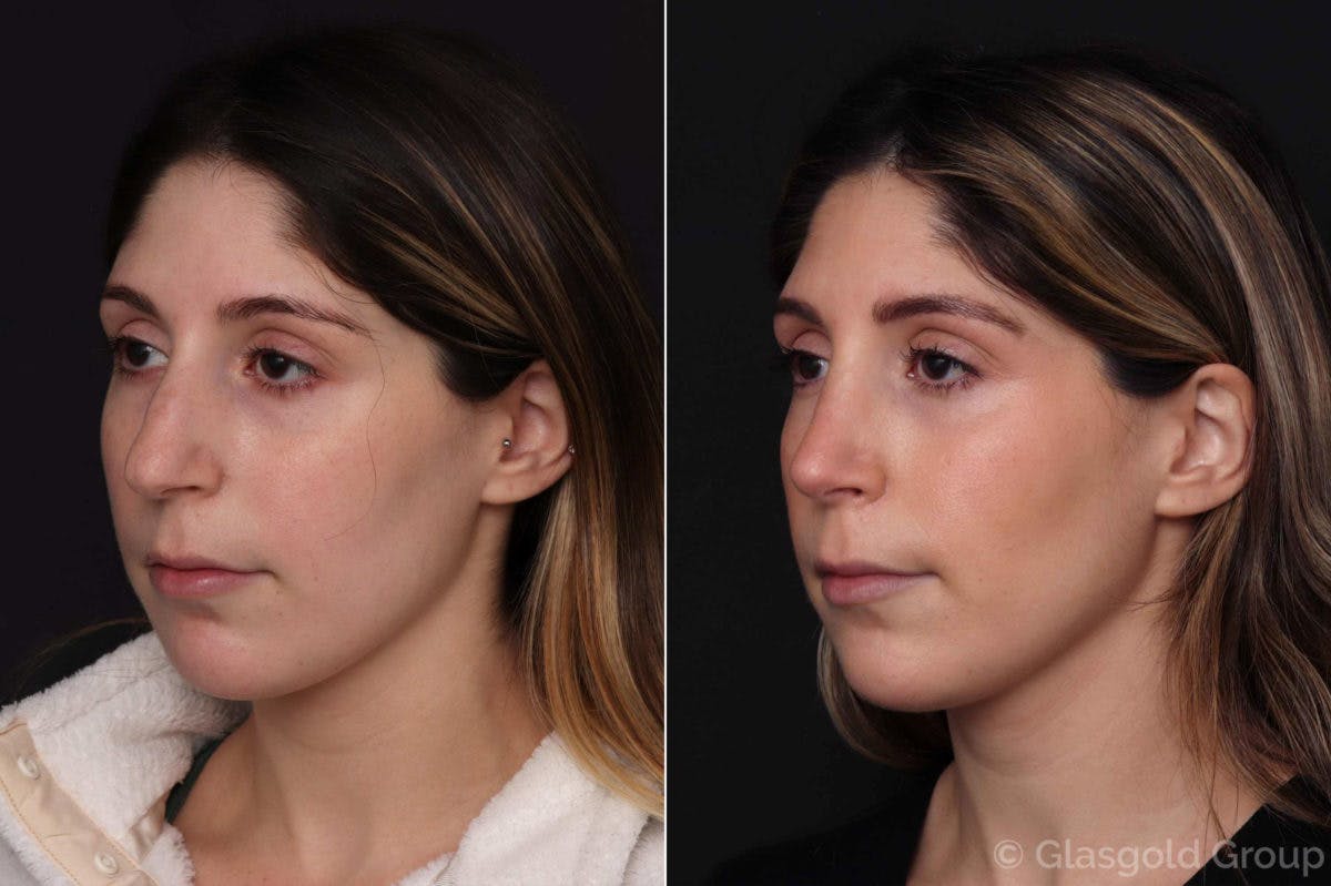 Rhinoplasty Before & After Gallery - Patient 670416 - Image 3