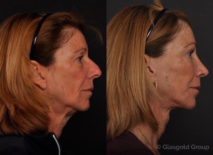 Fat Transfer Before & After Gallery - Patient 193634 - Image 2