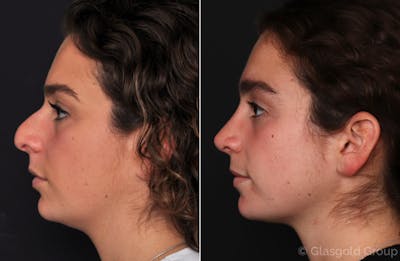 Rhinoplasty Before & After Gallery - Patient 146508 - Image 1