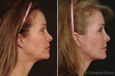 Facelift Before & After Gallery - Patient 642553 - Image 1