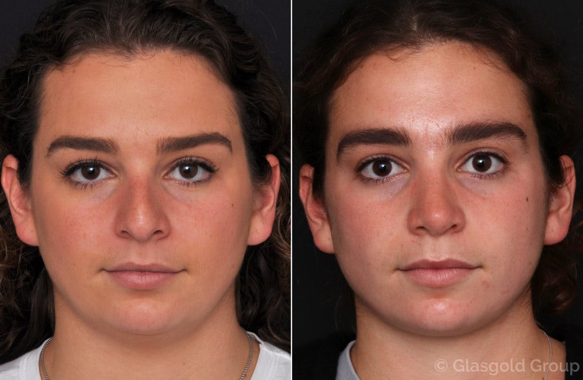 Rhinoplasty Before & After Gallery - Patient 146508 - Image 2