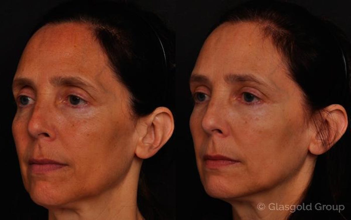 Upper Eyelid Rejuvenation Before & After Gallery - Patient 187849 - Image 1