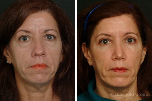 Fat Transfer Before & After Gallery - Patient 104515 - Image 2