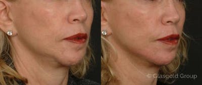 Jawline Lower Face Rejuvenation Before & After Gallery - Patient 365480 - Image 1