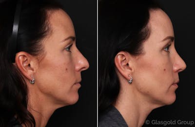 Rhinoplasty Before & After Gallery - Patient 380575 - Image 1