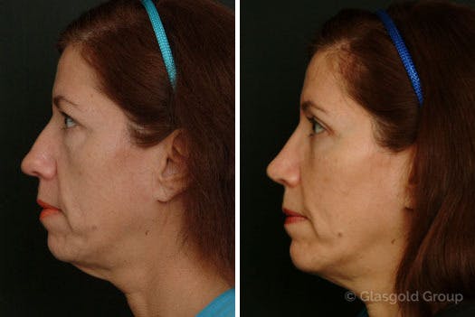 Fat Transfer Before & After Gallery - Patient 104515 - Image 1