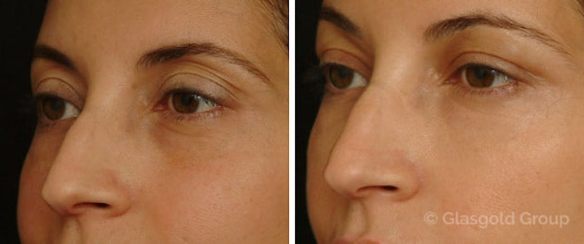 Upper Eyelid Rejuvenation Before & After Gallery - Patient 276327 - Image 1