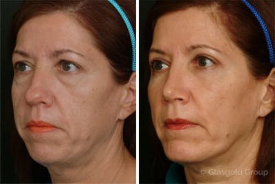 Fat Transfer Before & After Gallery - Patient 104515 - Image 1
